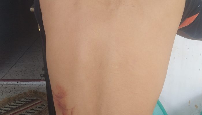 “MABUK”, Oknum Dokter Forensik RSUD Djasamen Saragih dan Oknum Pejabat Pajak Tanjung Pinang Aniaya ASN Satpol PP