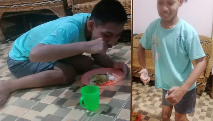 16 Tahun Disabilitas, Rapi Anak Kembar di Asahan Hidup Tanpa Bantuan: “Kalau Bisa Dapat Dana untuk Perawatan”